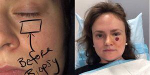 Mujer creía que solo era una espinilla pero resultó ser cáncer