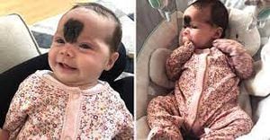 Bebê nasce com marca na testa e seus pais querem operá-la, mas médicos recusam