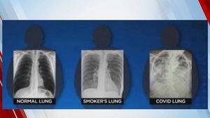 Pulmões de pacientes curados da Covid-19 ficam com mais danos que os dos fumantes