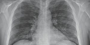 Coronavirus: Inteligencia Artificial aprende a detectar Covid-19 con radiografías