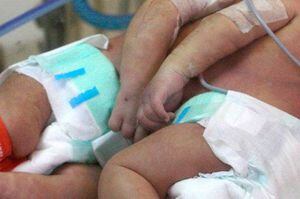 Médicos del Roosevelt inician evaluaciones a siameses nacidos en Petén