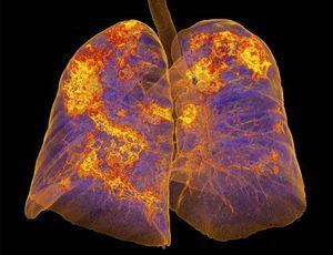 ¿Qué les pasa a tus pulmones de acuerdo a la gravedad del cuadro de coronavirus?