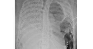Hospital dos EUA faz primeiro transplante duplo de pulmão em paciente com covid-19