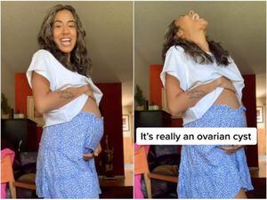 Mulher viraliza ao mostrar cisto no ovário que parece gravidez