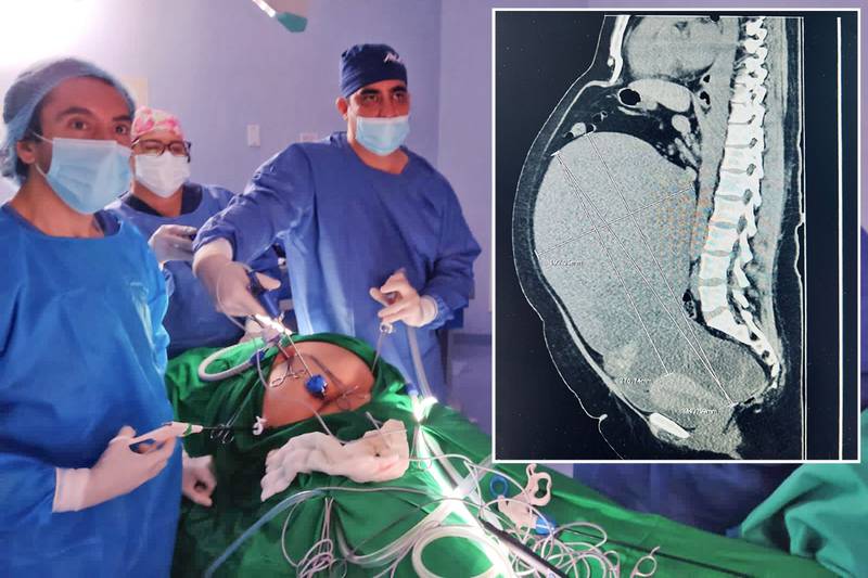 Durante la intervención, los especialistas se encontraron con un tumor de gran tamaño.