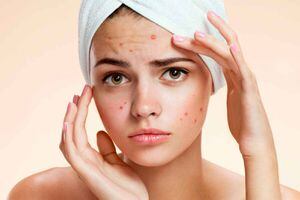 Aprenda a combatir el acné después de los 30