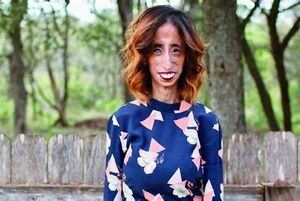 Lizzie Velásquez nació con dos enfermedades raras y con su historia intenta cambiar el mundo