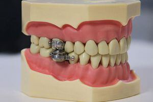 ¿Un candado o un instrumento de tortura? Desarrollan un dispositivo dental para perder peso