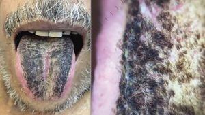 Diagnostican a un hombre con el raro síndrome de lengua peluda negra