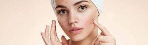 3 remedios naturales para combatir el acné