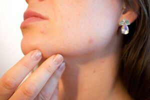 Remedios naturales para tratar el acné