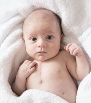 Un bebé con medio corazón sobrevive a dos cirugías de alto riesgo al nacer