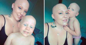 Contra preconceito, mulher posta fotos suas e de sua filha completamente carecas