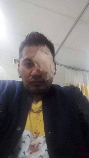 Paro nacional: Joven tiene riesgo de perder su ojo derecho tras impacto de bomba lacrimógena