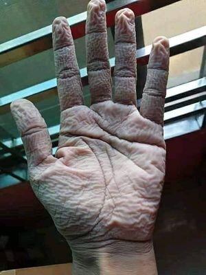Médico sube foto de su mano tras usar por 10 horas guante protector y revienta las redes