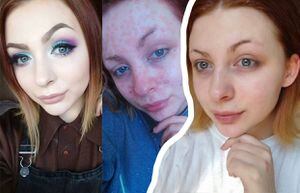 Vivía atada al maquillaje porque le apenaba el aspecto de su rostro debido a una enfermedad