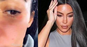 Kim Kardashian muestra su rostro sin maquillaje y deja ver lo difícil que es vivir con psoriasis
