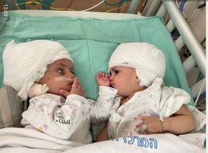 Confira o momento emocionante em que as gêmeas siamesas se olharam pela primeira vez após a cirurgia de separação