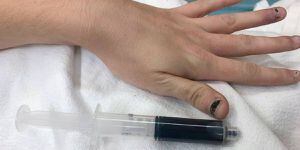 Medicamento para el dolor de muelas le volvió azul la sangre a una mujer
