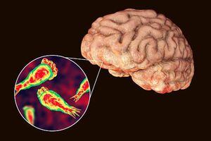 Ameba come cerebros: estos los síntomas de la enfermedad que alertó a Florida