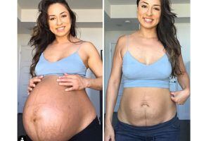 Ela viralizou ao mostrar seu corpo real antes e depois de dar à luz a gêmeos