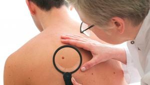 Hombres con altos niveles de testosterona son más propensos a desarrollar cáncer de piel