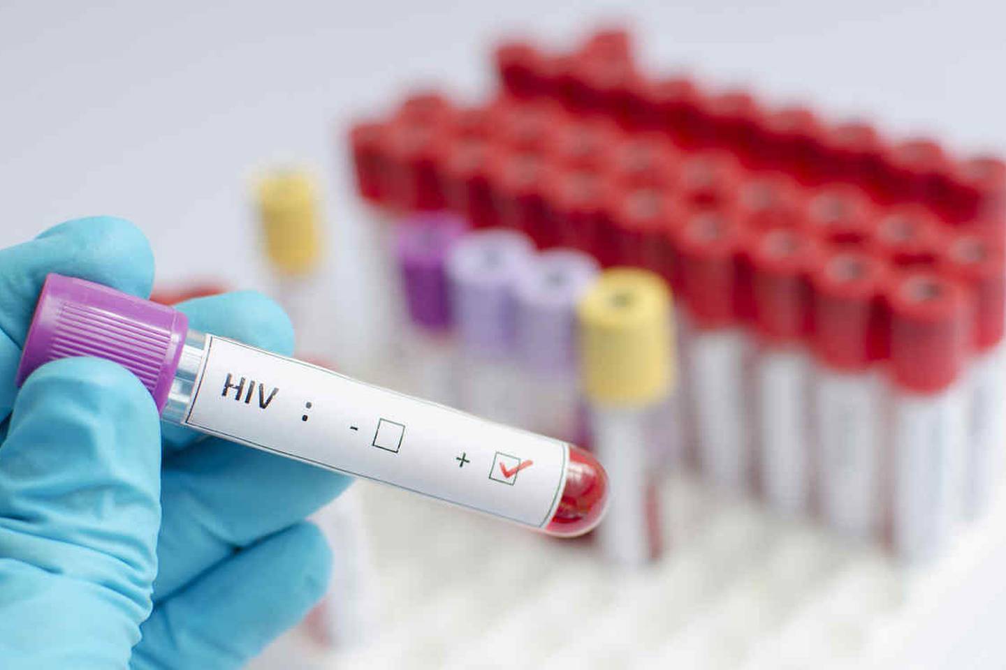 Las estadísticas muestran que una de cada siete personas no sabe que es portadora del VIH y que esto crea una cadena de contagio que debe detenerse.