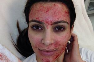 Spa contagia de VIH a clientas por hacer el famoso 'facial vampiro'