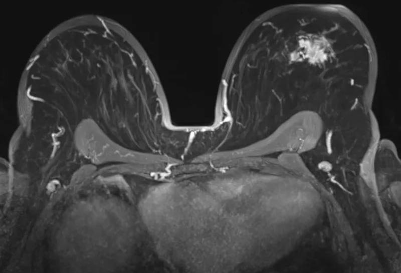 Resonancia magnética (MRI), cuándo se utiliza para explorar los senos.| Foto: Cortesía