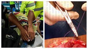 Impactantes fotos de la reconstrucción de muslo de Giovani dos Santos tras lesión