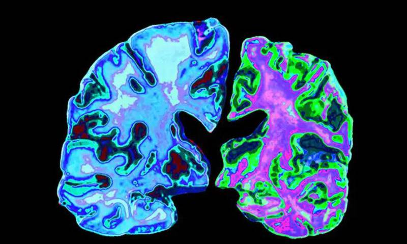 Nuevo estudio puede ayudar a detectar el Alzheimer con años de anticipación | Foto: Referencial