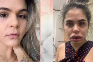Dezenas de mulheres são enganadas ao fazer harmonização facial e ficam com rostos deformados