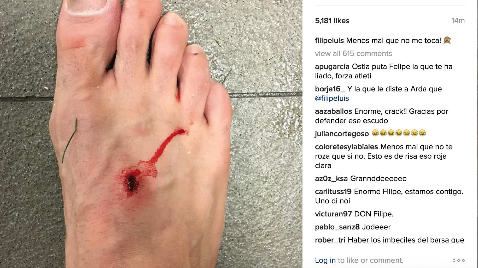 Así quedó el pie de Filipe tras dura entrada de Luis Suárez