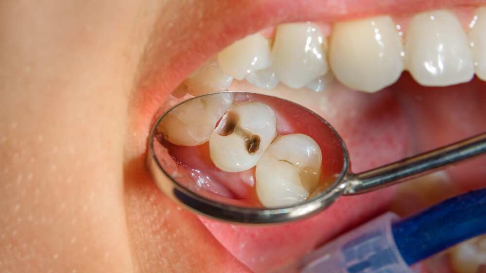 Las caries generan dolor de muela.