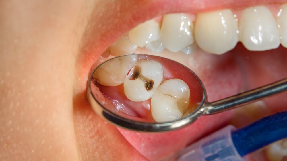 Las caries generan dolor de muela.