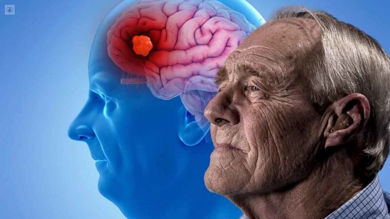 Alzheimer | Foto: Infobae