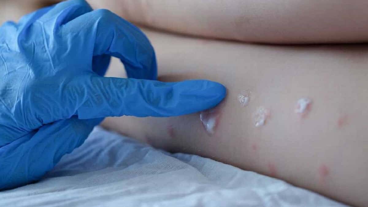 La viruela del mono genera protuberancias que pueden parecer ampollas.