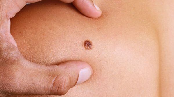 La sobreexposición al sol atenta contra la salud de la piel.
