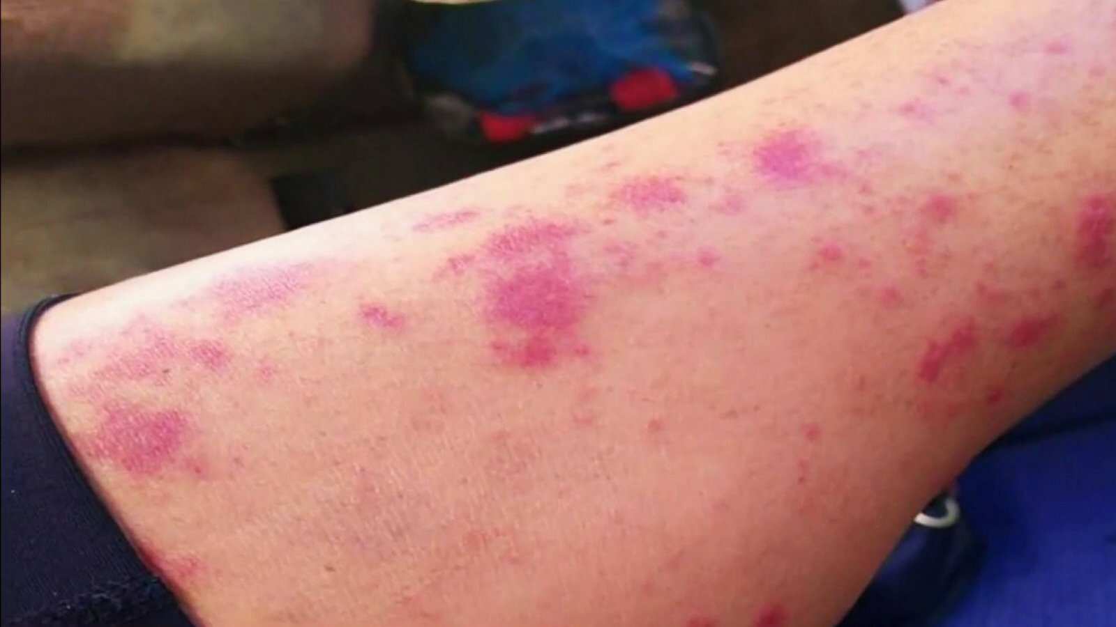 La primera demostración de la bateria come carne en la piel, son un sarpullido de manchas rojas, si presenta este sintoma acuda al médico | Foto: Referencial