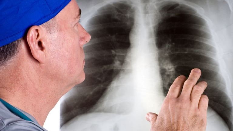 Las tasas de mortalidad por cáncer de hígado subieron significativamente en el oeste del país.