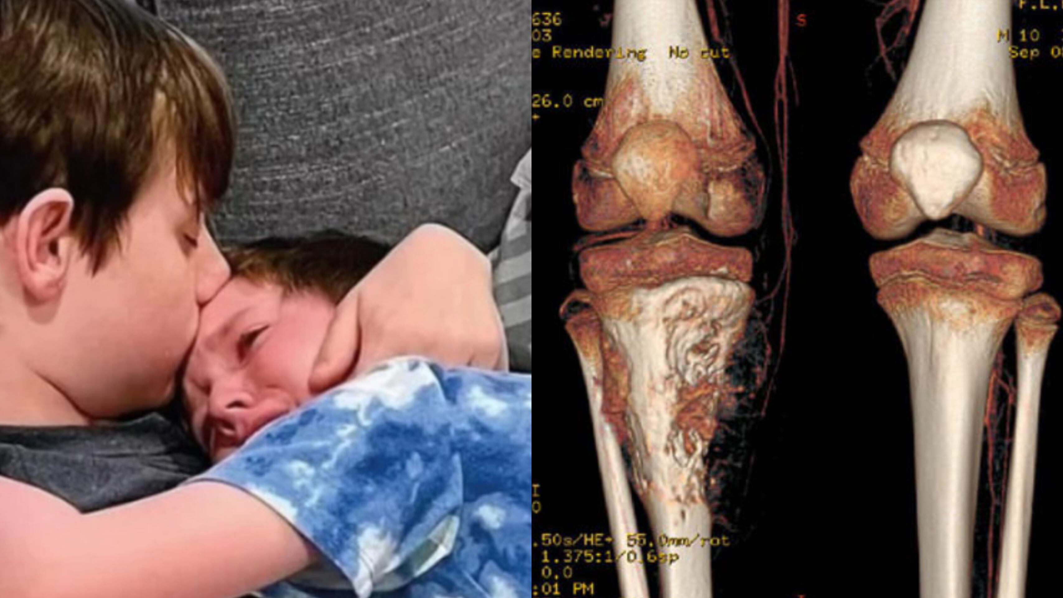 Osteosarcoma