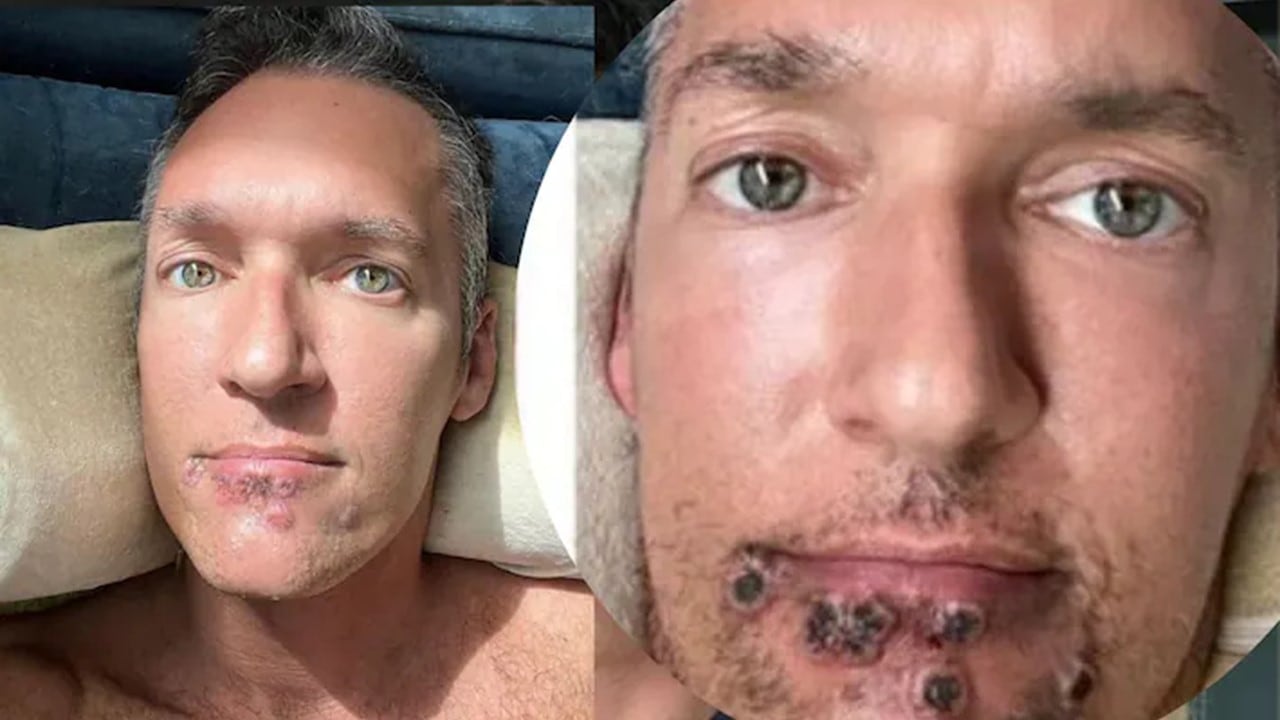 La viruela del mono le ocasionó lesiones en el rostro al actor porno Silver Steele.