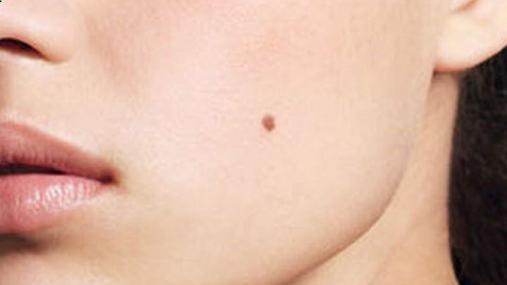 Los lunares con vello podrían ser la clave para curar la calvicie.