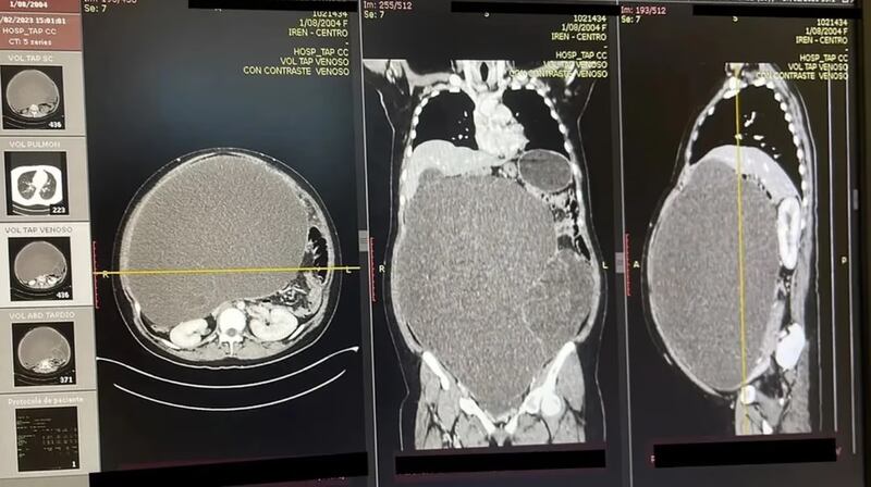 De 20 kilos era el tumor que sufría una joven en Perú.