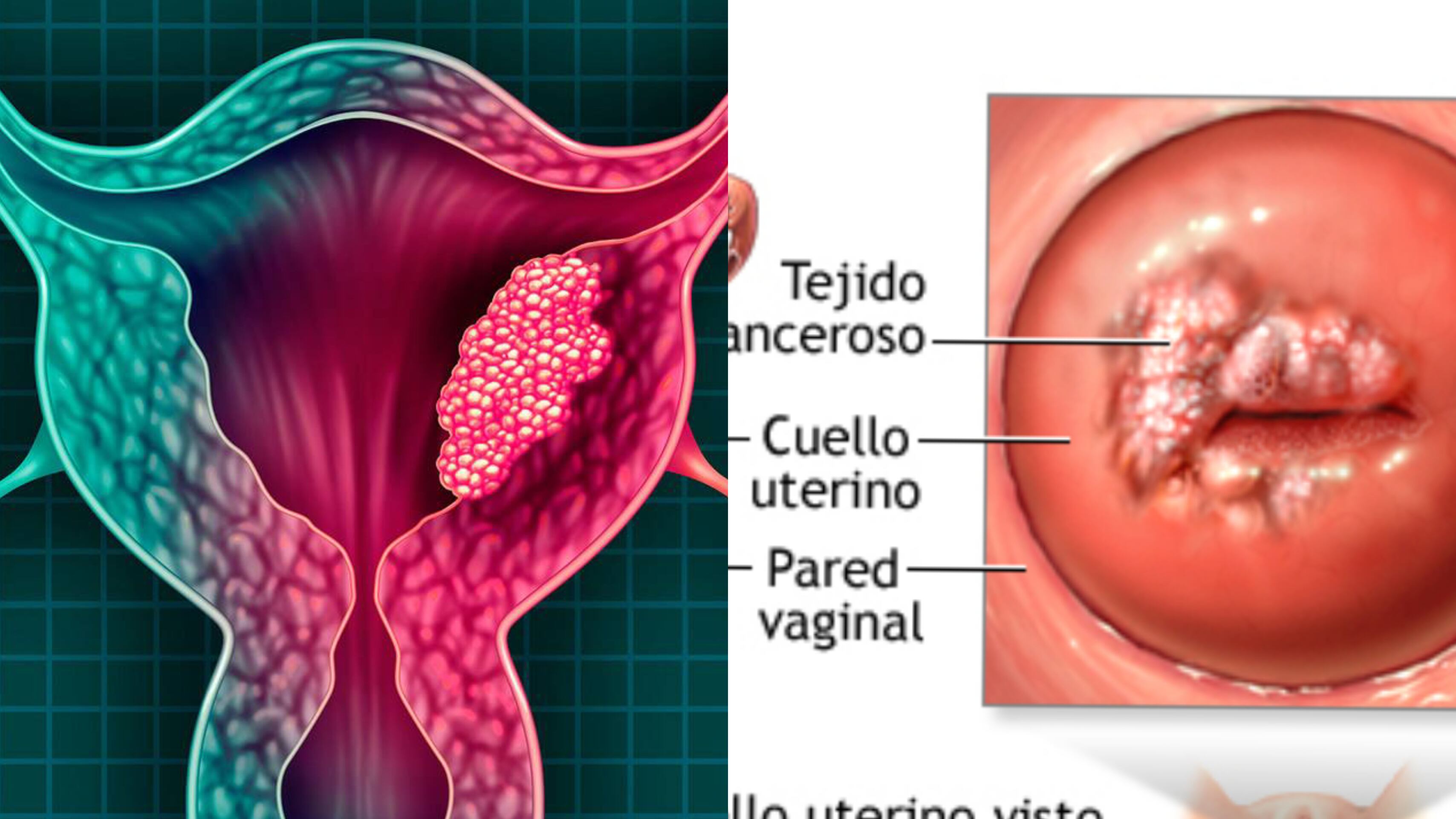 Cáncer de cuello uterino
