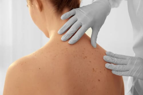 Los granos en la piel podrían ser cáncer y cómo reconocer los signos