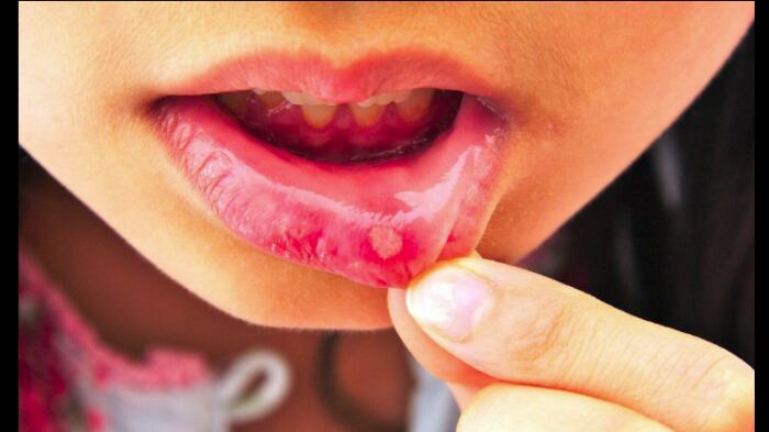 Los hongos del género cándida generan infecciones en varias zonas del cuerpo.