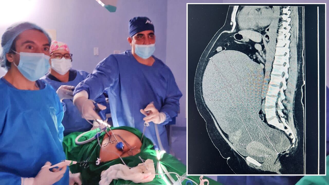 Durante la intervención, los especialistas se encontraron con un tumor de gran tamaño.