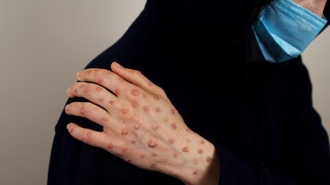 Paciente con viruela del mono.