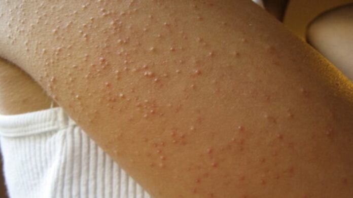 Para la sarna, especialista sugiere usar crema con permetrina al 1 %.